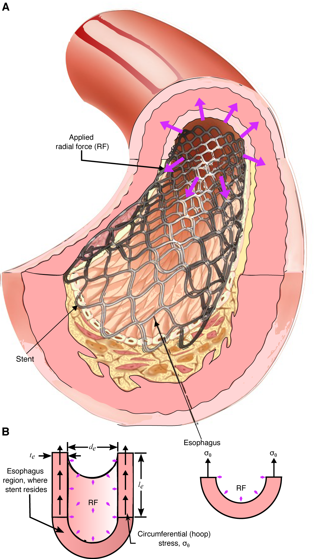 Cross-section and free body diagram of stented esophagus showing applied radial force and hoop stress