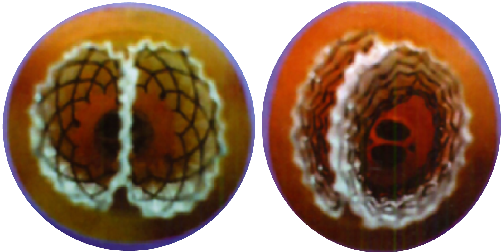 Normal versus buckled stent in RoSE